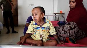 世界の奇病 近親婚が生んだバングラディシュの４歳児老人 アジア格安 ひとり旅ナビ助